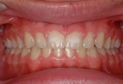 Overbite_After_080614.jpg